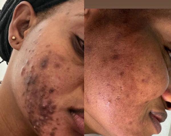 La Routine Complète Anti-imperfections