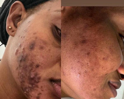La Routine Complète Anti-imperfections